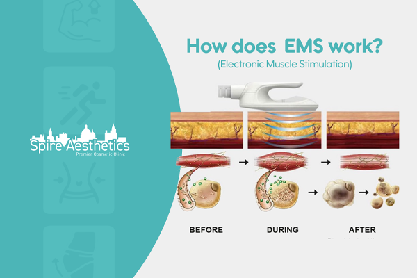 EMS treatment for post pregnancy weight loss treatment Loughborouogh