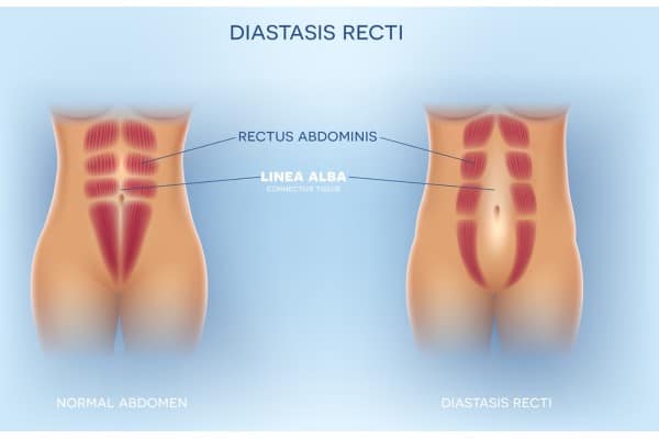 What Non-Surgical Options Are Available for Diastasis Recti Loughborouogh?