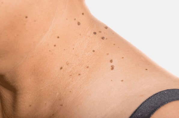 Are you looking for easy skin tag removal Loughborouogh - then contact Spire today!