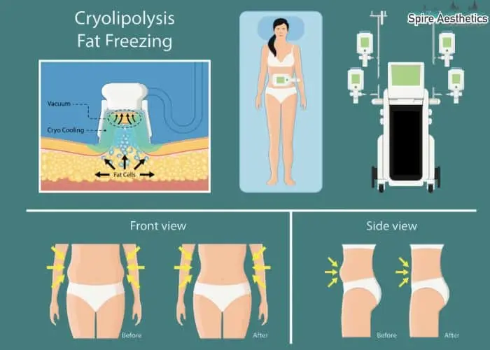 Fat freezing treatment Loughborouogh benefits for competitions to remove stubborn fat deposits.