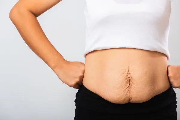 Image of a woman's stomach after weight loss with sagging skin following a gastric band Loughborouogh