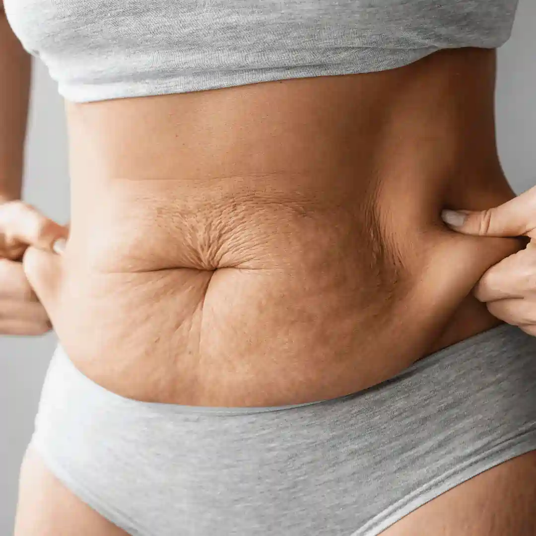 Is It Normal to Have Loose Skin After Pregnancy Loughborouogh?