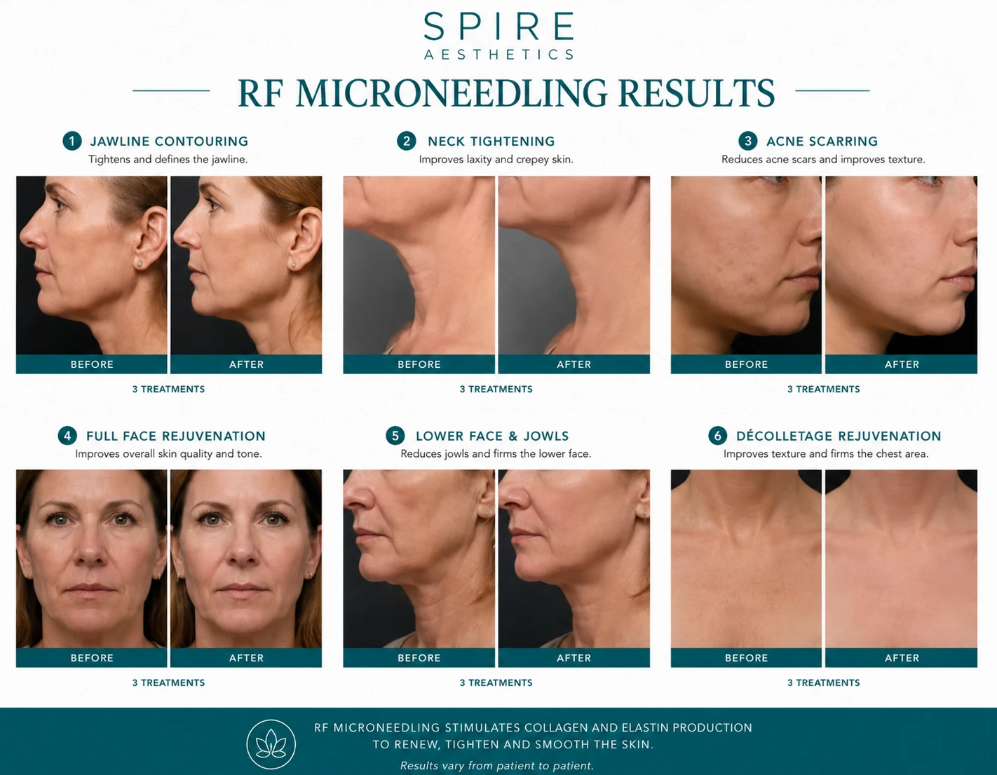 RF Microneedling Skin tightening Loughborouogh results