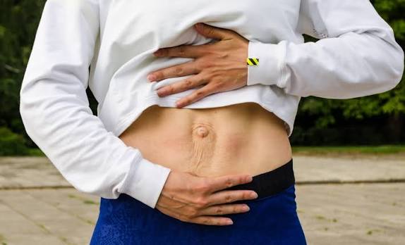 When Could Diastasis Recti Be the Missing Piece of the Puzzle Loughborouogh?