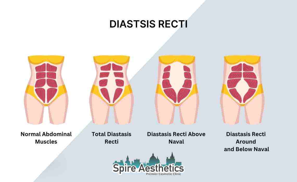 Is Non-Surgical Diastasis Recti Treatment Right for You? Common Concerns Answered Loughborouogh